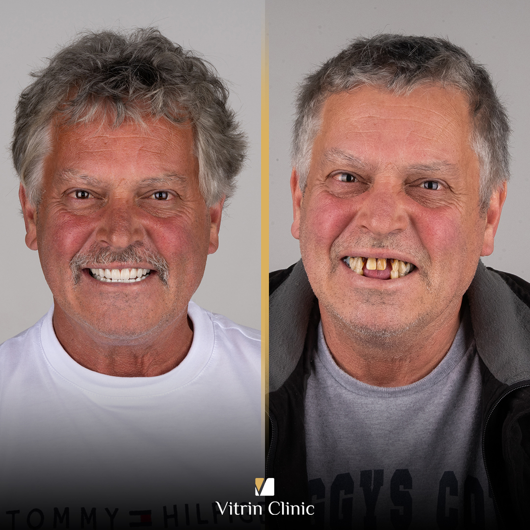 Frank dental implants